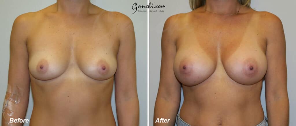 Breast Augmentation Before and After Photo by Ganchi Plastic Surgery in Northern New Jersey