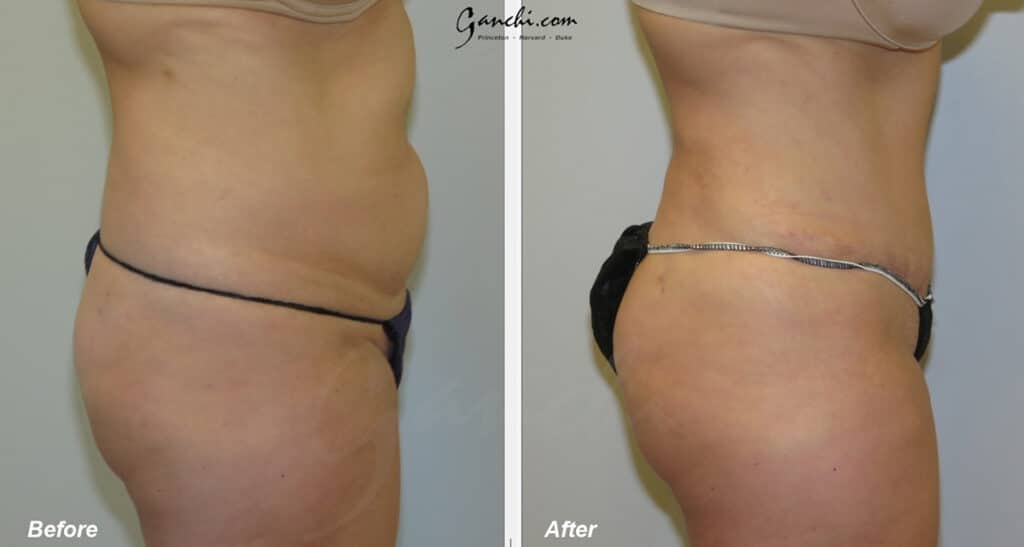 Tummy Tuck Before and After Photo by Ganchi Plastic Surgery in Northern New Jersey