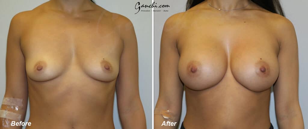 Breast Augmentation Before and After Photo by Ganchi Plastic Surgery in Northern New Jersey