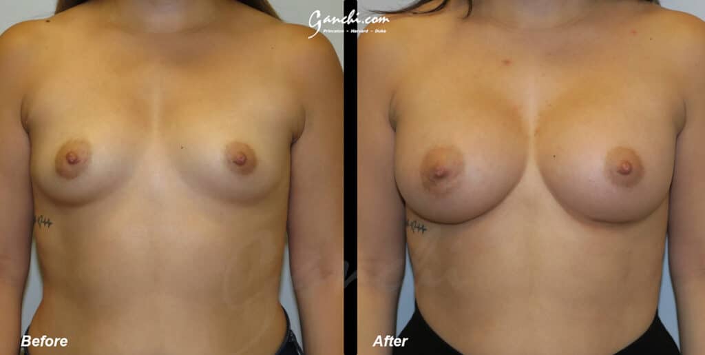 Breast Augmentation Before and After Photo by Ganchi Plastic Surgery in Northern New Jersey