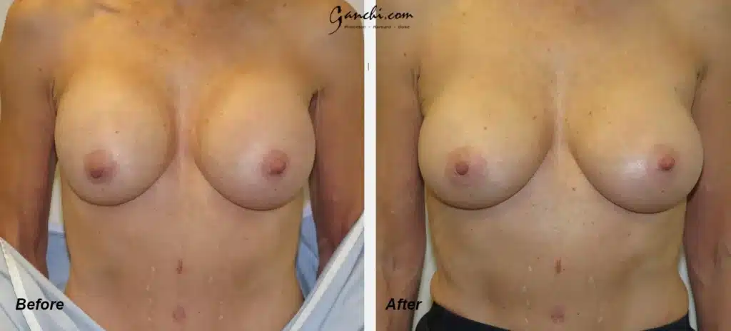 Front View Breast Implant Revision Before and After Photo by Ganchi Plastic Surgery in Northern New Jersey
