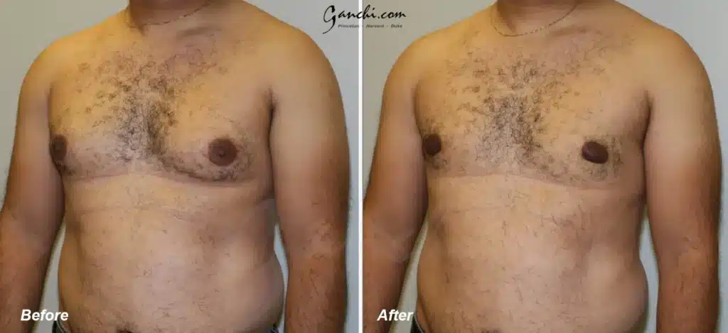 Oblique View Gynecomastia Before and After Photo by Ganchi Plastic Surgery in Northern New Jersey