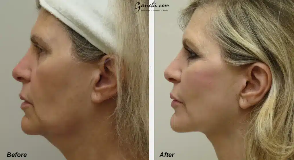 Side View Faceneck Lift Before and After Photo by Ganchi Plastic Surgery in Northern New Jersey