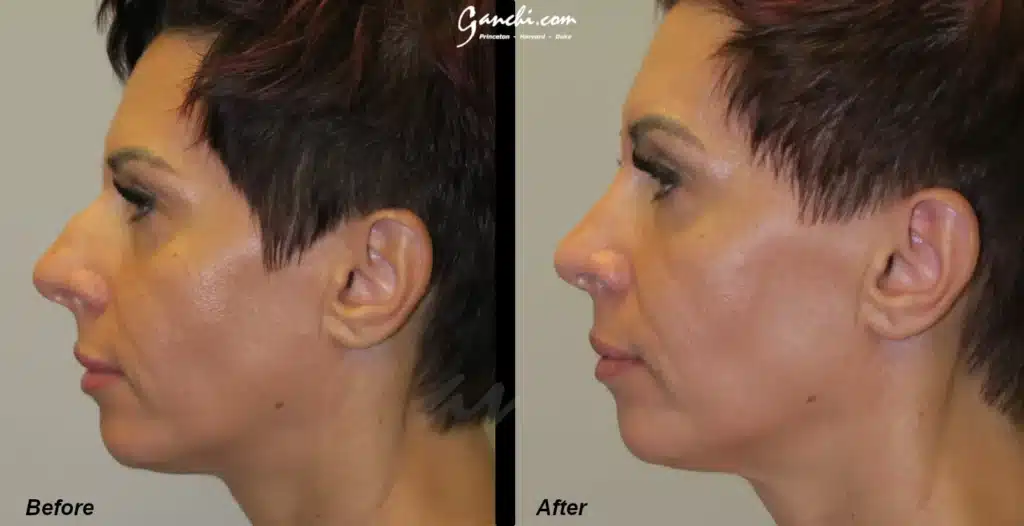 Side View Rhinoplasty Before and After Photo by Ganchi Plastic Surgery in Northern New Jersey