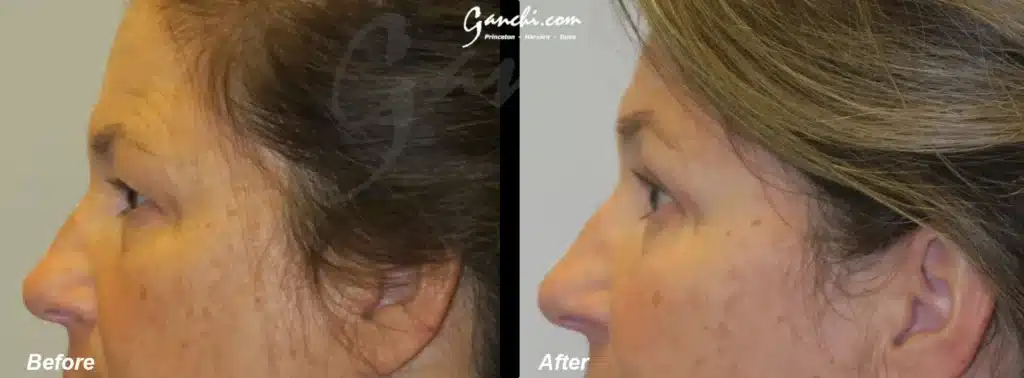 Side View Upper Blepharoplasty Before and After Photo by Ganchi Plastic Surgery in Northern New Jersey