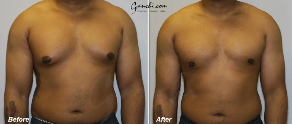 Front View Gynecomastia Before and After Photo by Ganchi Plastic Surgery