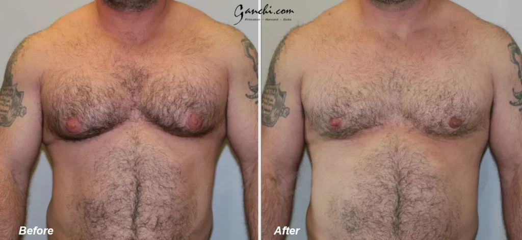 Front View Gynecomastia Before and After Photo by Ganchi Plastic Surgery