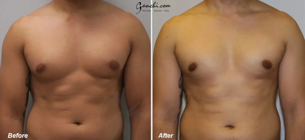 Front View Gynecomastia Before and After Photo by Ganchi Plastic Surgery