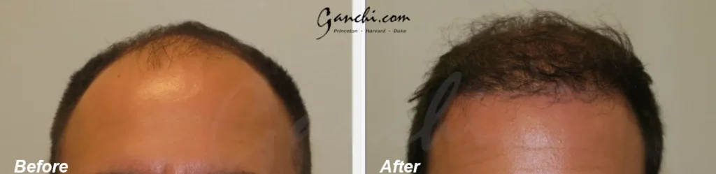 Front View Hair Transplant Before and After Photo by Ganchi Plastic Surgery