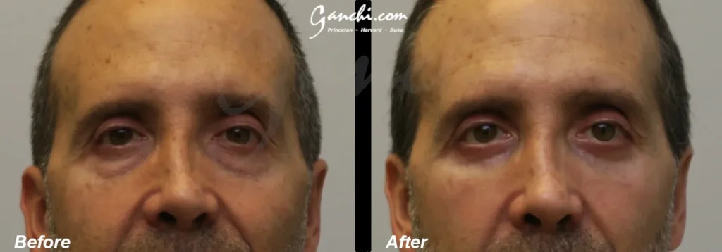 Front View Lower Blepharoplasty Before and After Photo by Ganchi Plastic Surgery
