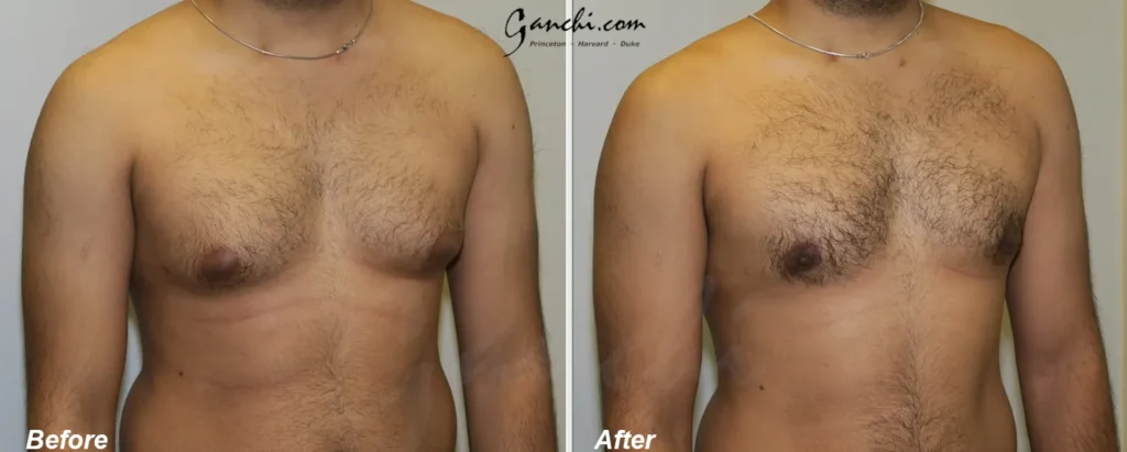 Oblique Right View Gynecomastia Before and After Photo by Ganchi Plastic Surgery