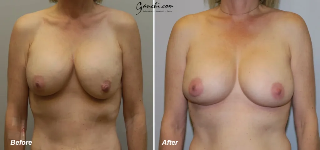 Front View Breast Implant Revision Before and After Photo by Ganchi Plastic Surgery