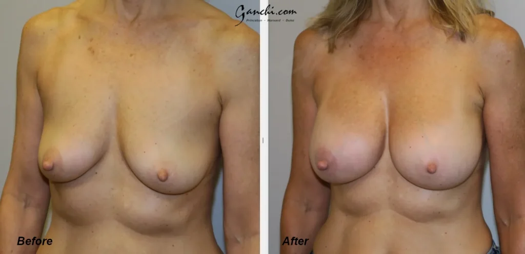 Left Oblique View Breast Augmentation Before and After Photo by Ganchi Plastic Surgery