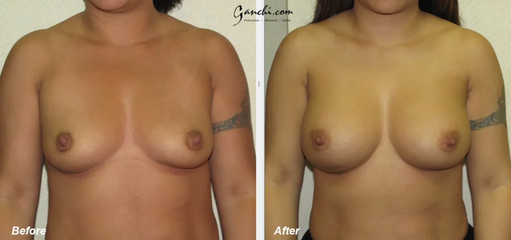 Front View Breast Augmentation Before and After Photo by Ganchi Plastic Surgery