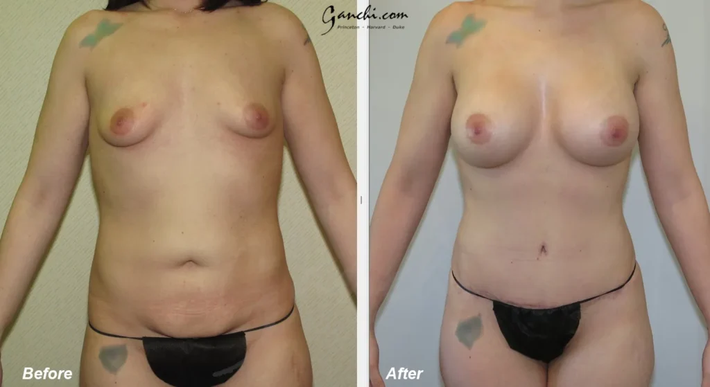 Front View Breast Implant Exchange Before and After Photo by Ganchi Plastic Surgery