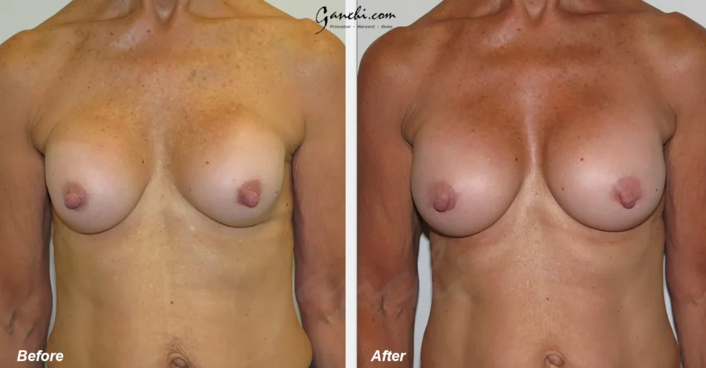 Front View Breast Implant Exchange Before and After Photo by Ganchi Plastic Surgery