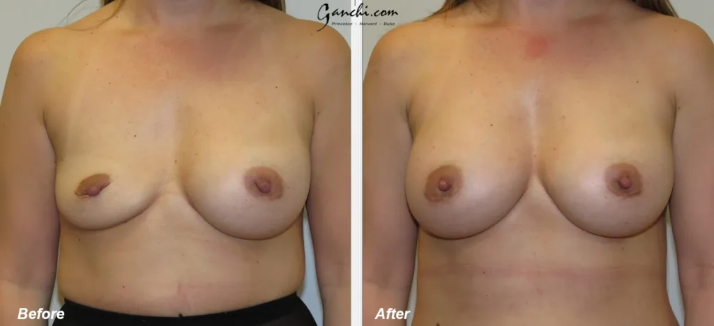 Front View Breast Implant Revision Before and After Photo by Ganchi Plastic Surgery