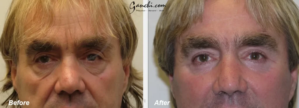 Front View Eyelid Lift Before and After Photo by Ganchi Plastic Surgery