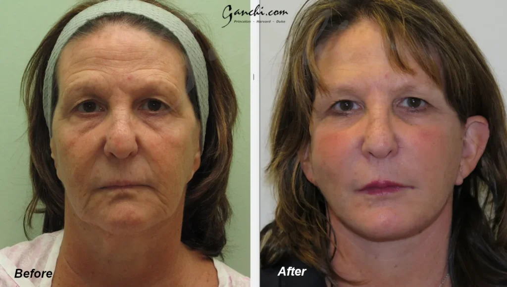 Front View Face Neck Lift Before and After Photo by Ganchi Plastic Surgery