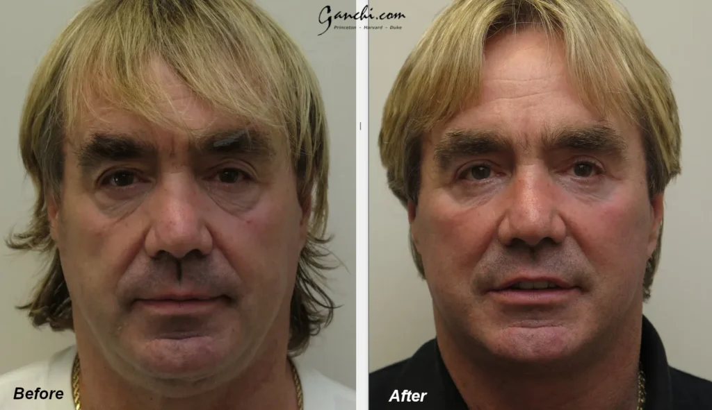 Front View Men Face Neck Lift Before and After Photo by Ganchi Plastic Surgery