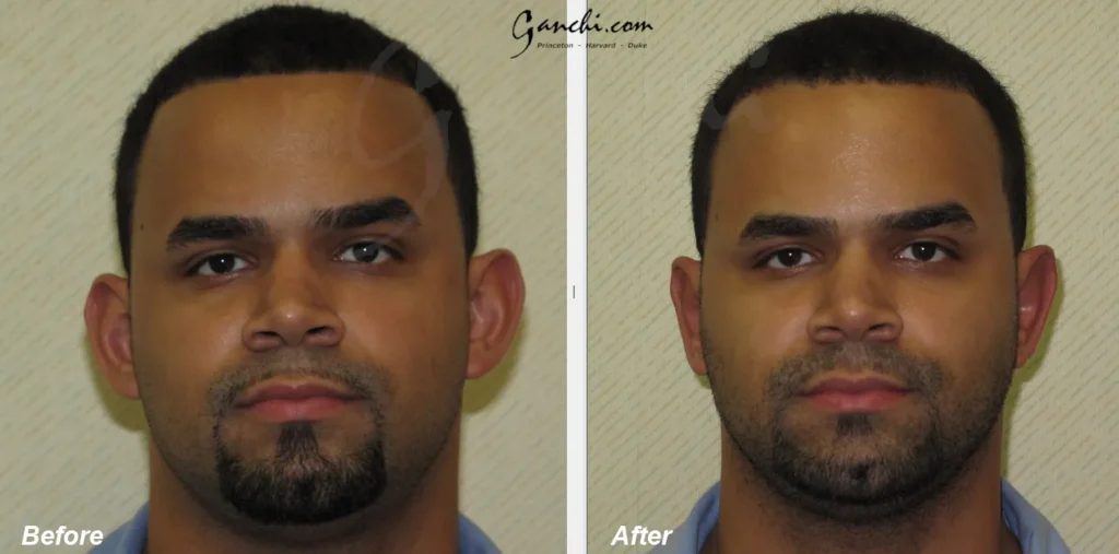 Front View Otoplasty Before and After Photo by Ganchi Plastic Surgery