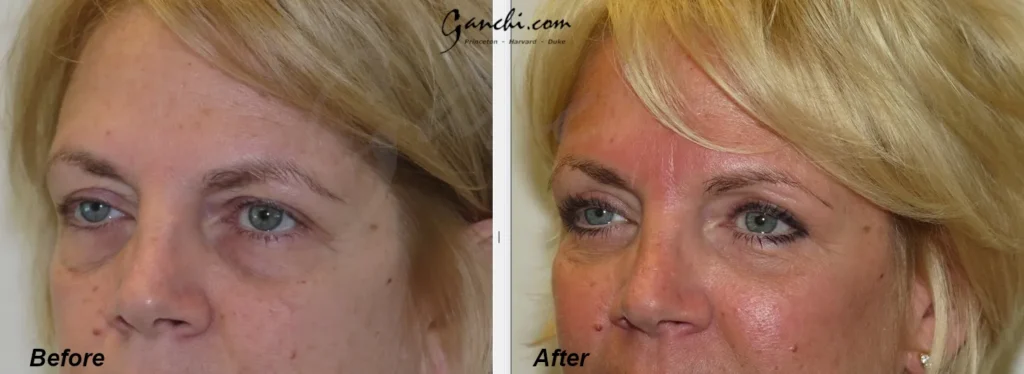 Left Oblique View Eyelid Lift Before and After Photo by Ganchi Plastic Surgery