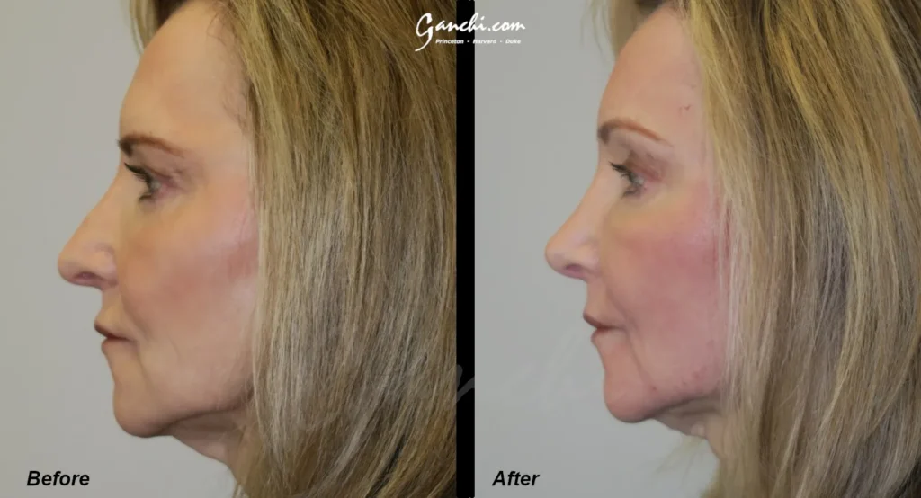 Left Side View Face Neck Lift Before and After Photo by Ganchi Plastic Surgery