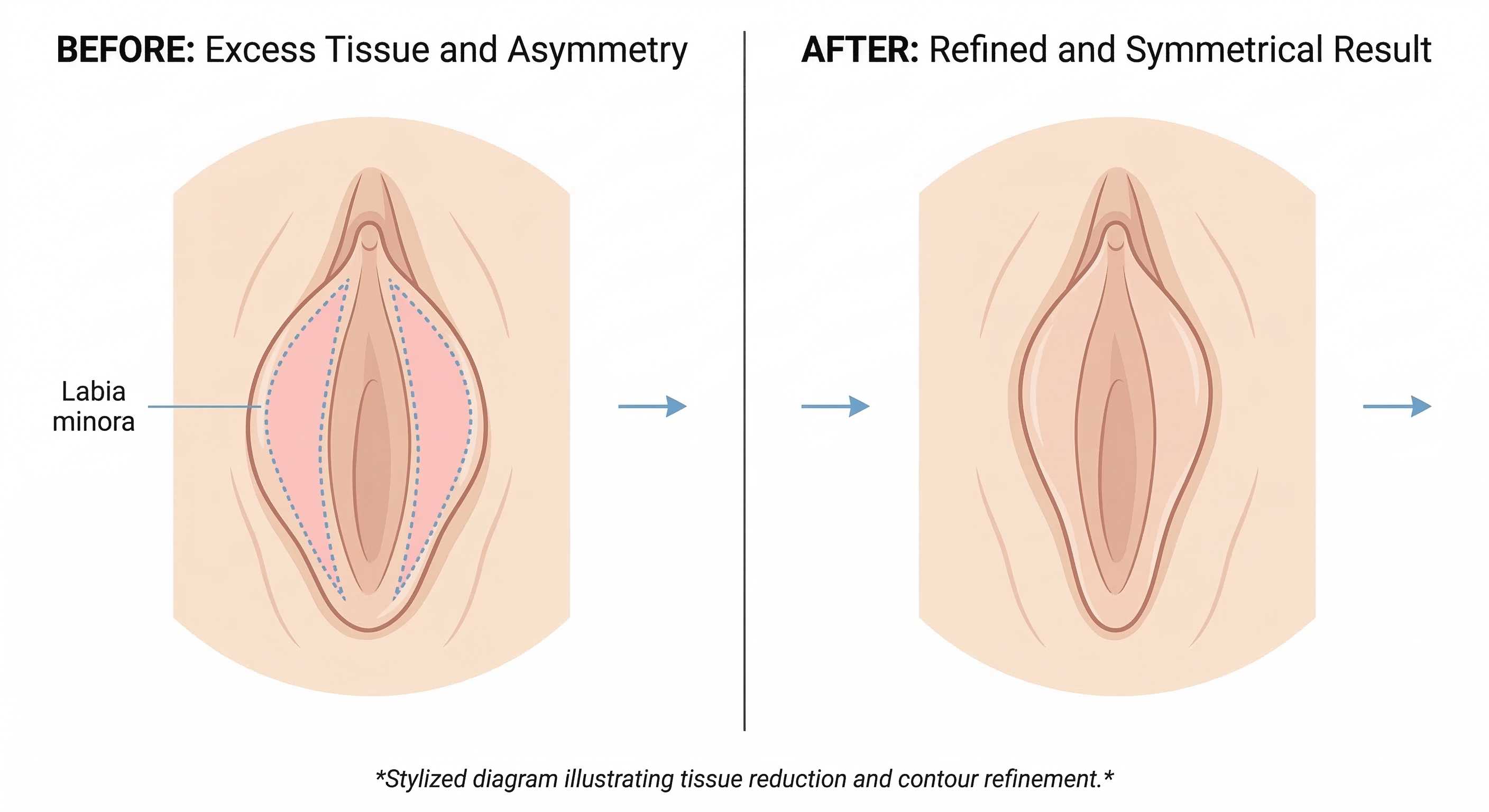 Labiaplasty before and after medical illustration showing surgical tissue reduction and symmetry in Wayne, NJ.
