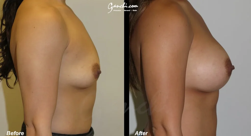 Right Side View Breat Augmentation Before and After Photo by Ganchi Plastic Surgery
