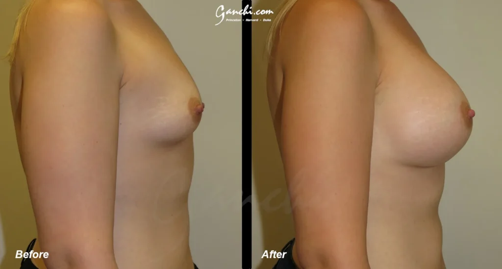 Right Side View Breat Augmentation Before and After Photo by Ganchi Plastic Surgery