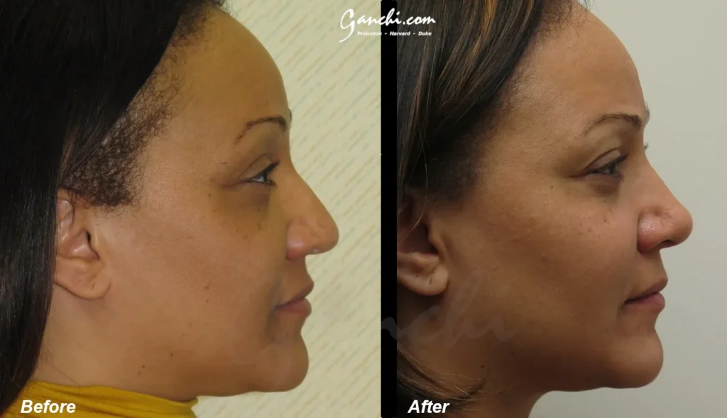Right Side View Face Neck Lift Before and After Photo by Ganchi Plastic Surgery