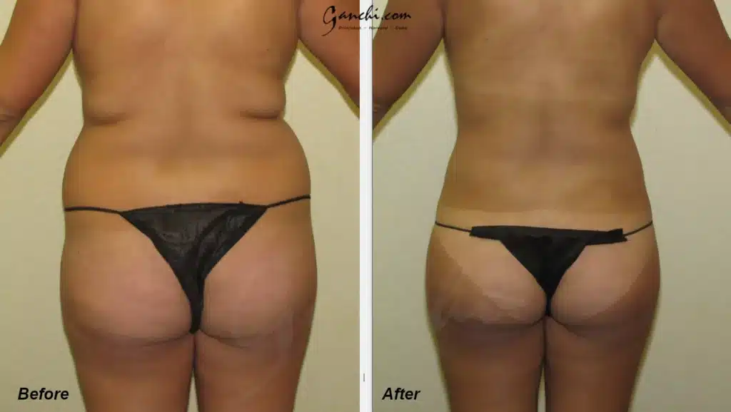 Back View Liposuction Flanks Before and After Photo by Ganchi Plastic Surgery
