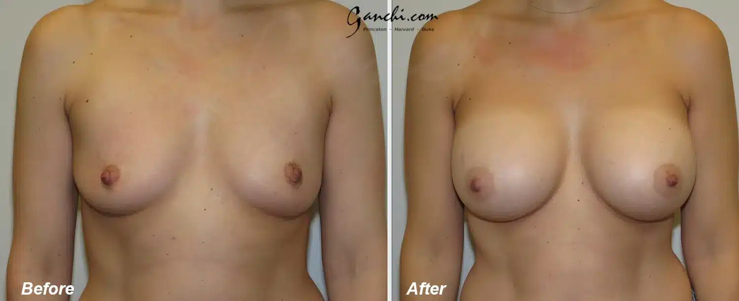 Front View Breast Augmentation Before and After Photo by Ganchi Plastic Surgery Front View Breast Augmentation Before and After Photo by Ganchi Plastic Surgery