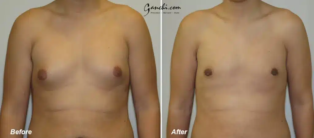 Front View Gynecomastia Before and After Photo by Ganchi Plastic Surgery