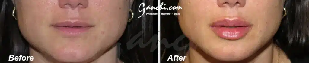 Front View Lip Augmentation Before and After Photo by Ganchi Plastic Surgery
