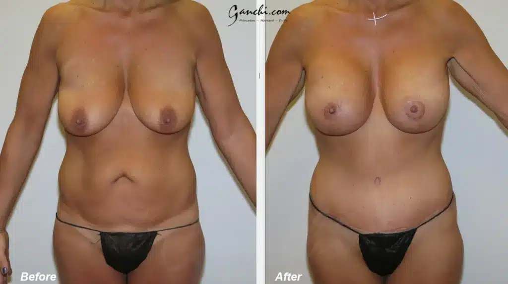 Front View Mommy Makeover Before and After Photo by Ganchi Plastic Surgery