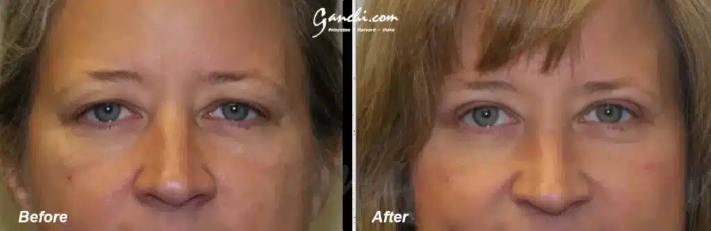 Front View Upper Blepharoplasty Before and After Photo by Ganchi Plastic Surgery