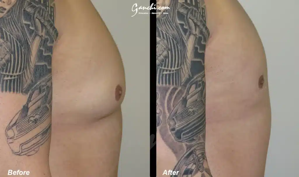 Right Side View Gynecomastia Before and After Photo by Ganchi Plastic Surgery