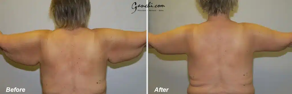 Back View Arm Lift Before and After Photo by Ganchi Plastic Surgery