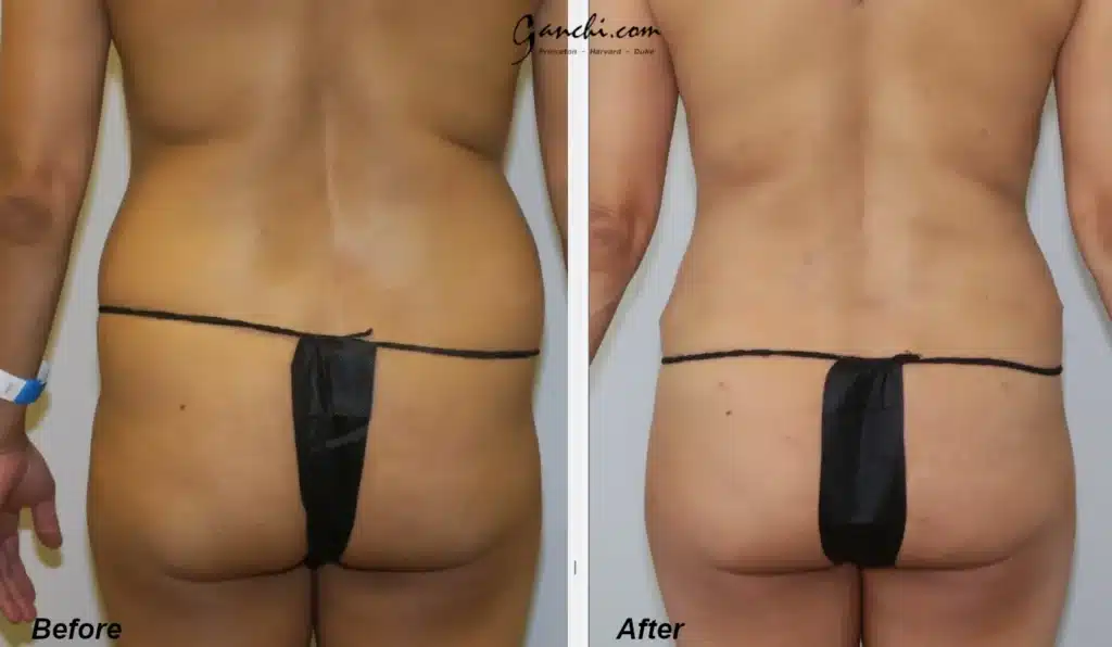 Back View Liposuction Before and After Photo by Ganchi Plastic Surgery