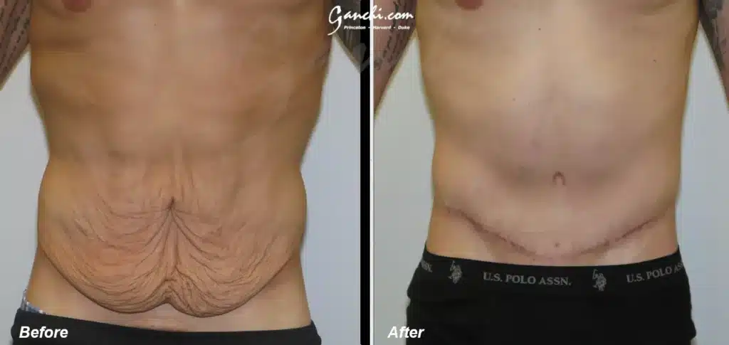 Front View Body Lift Before and After Photo by Ganchi Plastic Surgery