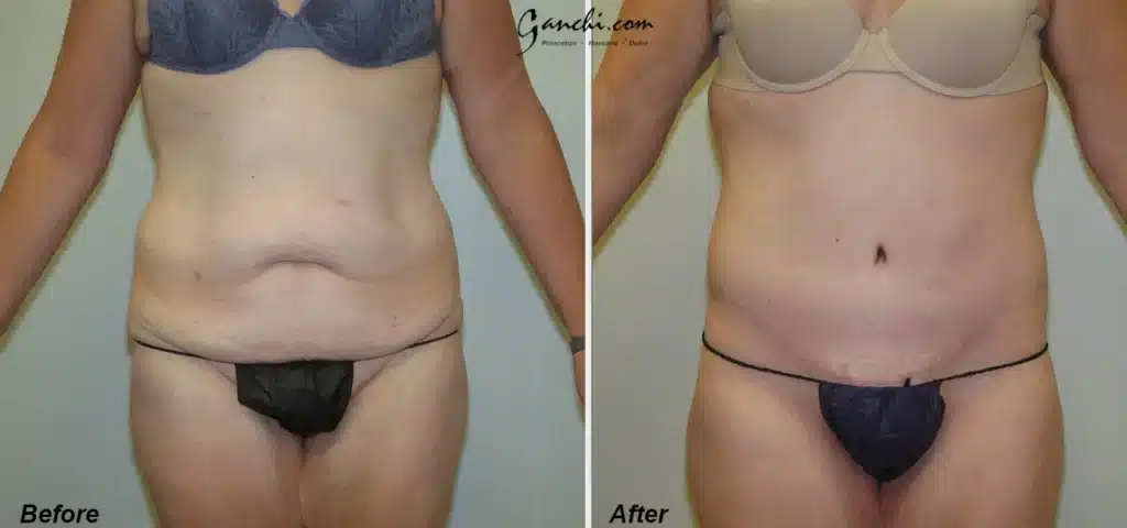 Front View Body Lift Before and After Photo by Ganchi Plastic Surgery