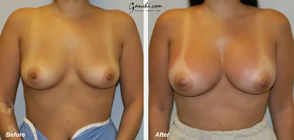 Front View Breast Augmentation Before and After Photo by Ganchi Plastic Surgery