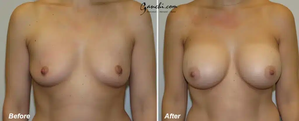 Front View Breast Augmentation Before and After Photo by Ganchi Plastic Surgery