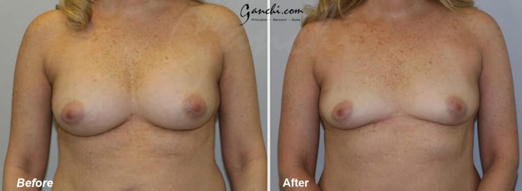 Front View Breast Implant Removal Before and After Photo by Ganchi Plastic Surgery
