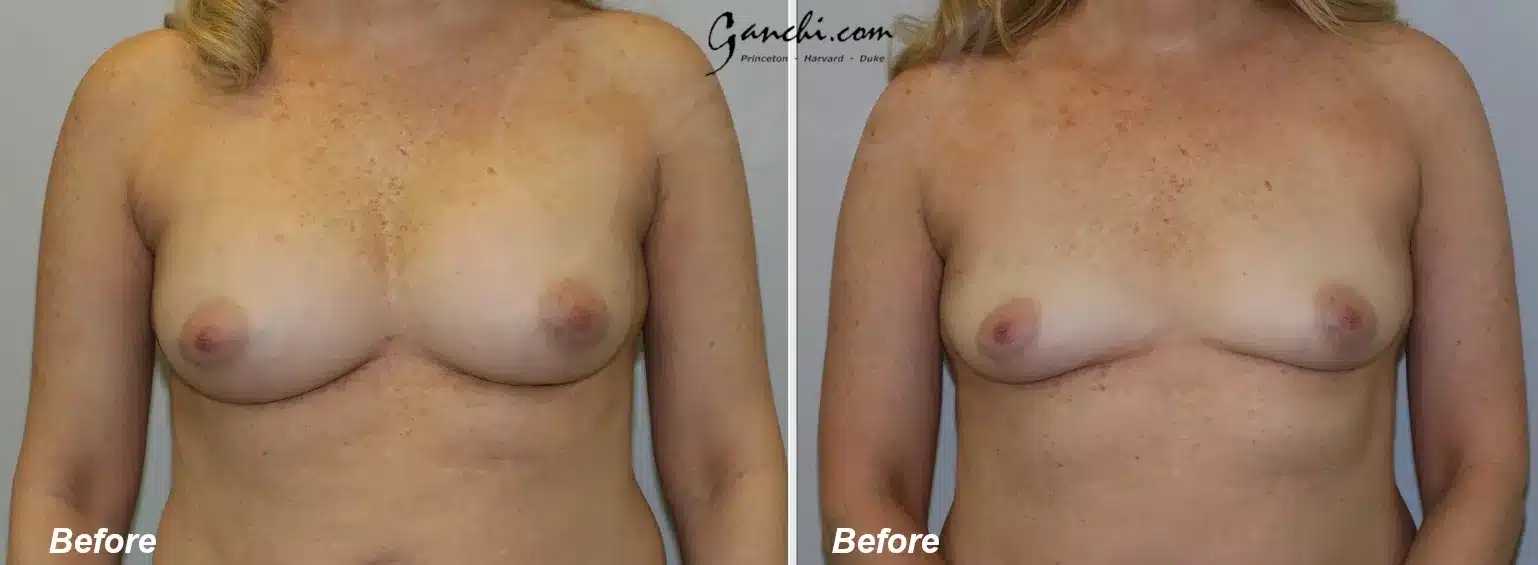 Front View Breast Implant Removal Before and After Photo by Ganchi Plastic Surgery