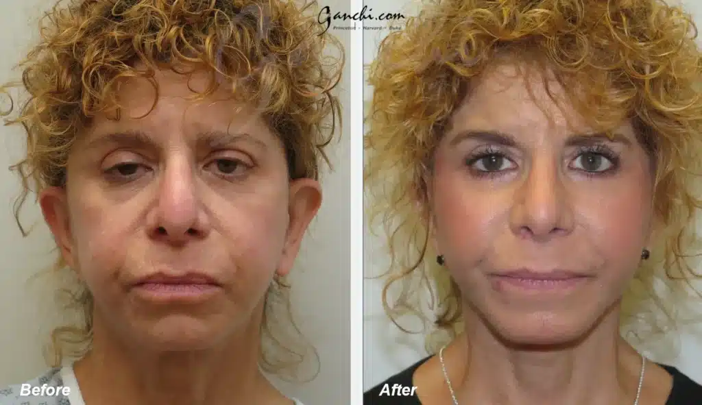 Front View Face and Neck Lift Before and After Photo by Ganchi Plastic Surgery