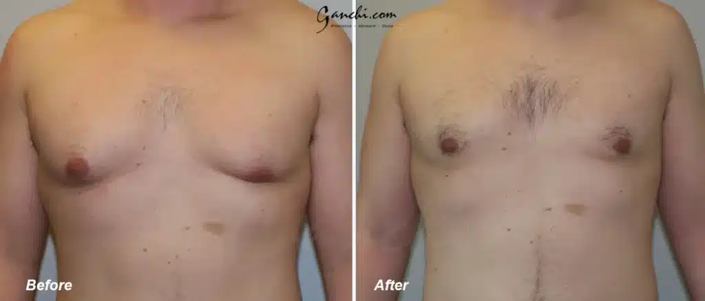 Front View Gynecomastia Before and After Photo by Ganchi Plastic Surgery