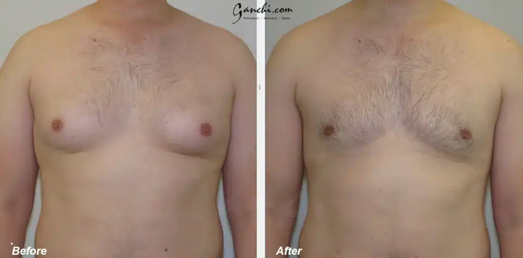 Front View Gynecomastia Before and After Photo by Ganchi Plastic Surgery