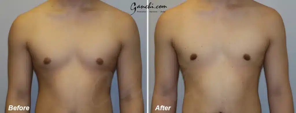 Front View Gynecomastia Before and After Photo by Ganchi Plastic Surgery
